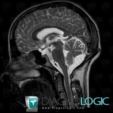 Epidermoid cyst, Posterior fossa, MRI