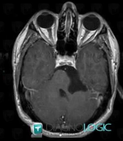 Epidermoid cyst, Posterior fossa, MRI