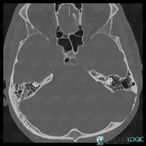 Epidermoid cyst, Skull vault, Temporal bone, CT