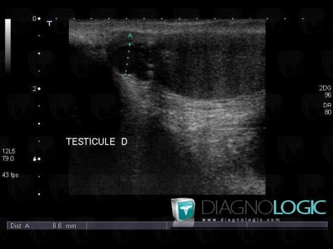 Epididymal cyst, Scrotum, US