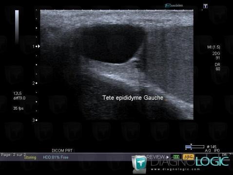 Epididymal cyst, Scrotum, US