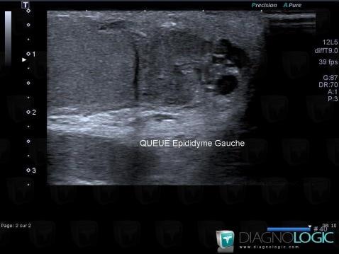 épididymite, Scrotum, Echographie