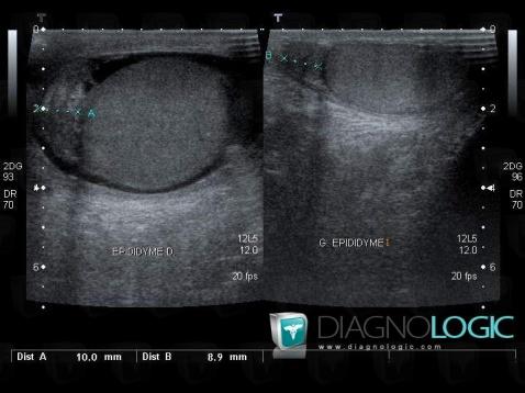 Epididymitis, Scrotum, US