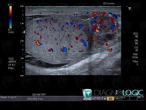 Epididymitis, Scrotum, US