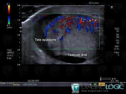 Epididymitis, Scrotum, US