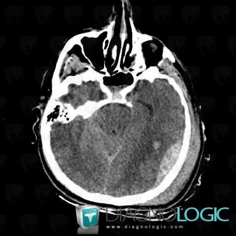 Epidural hematoma, Supratentorial peri cerebral spaces, CT