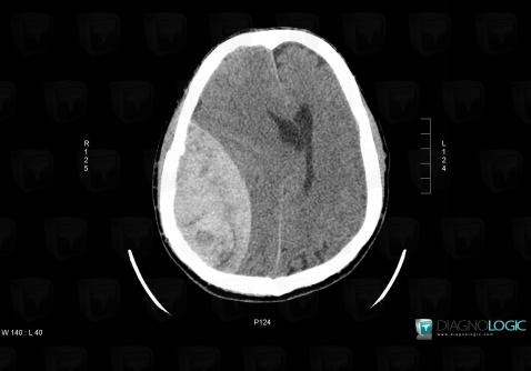 Epidural hematoma, Supratentorial peri cerebral spaces, CT