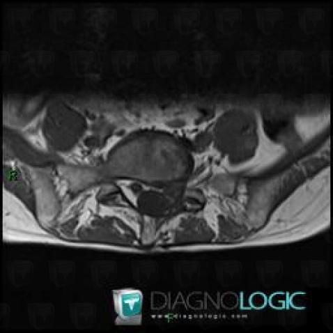 Epidural scar, Spinal canal / Cord, MRI