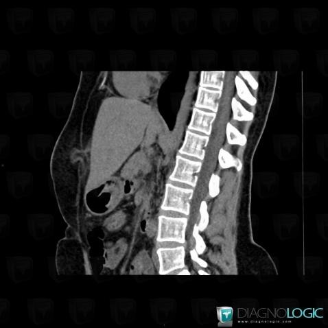 Epigastric hernia, Abdominal wall, CT