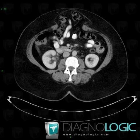 Epigastric hernia, Abdominal wall, CT