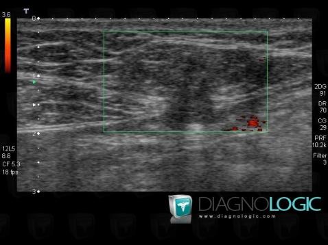Epigastric hernia, Abdominal wall, US