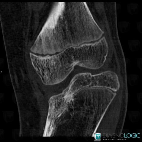 Epiphysiodèse, Tibia -supérieur, Scanner