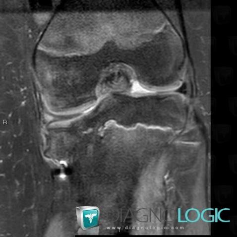 Epiphysiodesis, Tibia - Proximal part, MRI