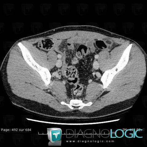 Epiploic appendagitis, Mesentery / Peritoneum, CT