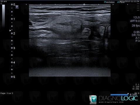 Epiploic appendagitis, Mesentery / Peritoneum, US