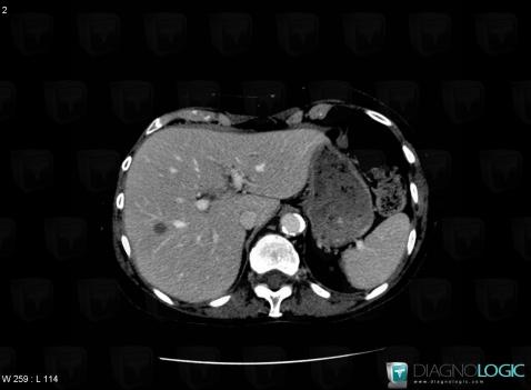 Epithelioid hemangioendothelioma, Liver, CT