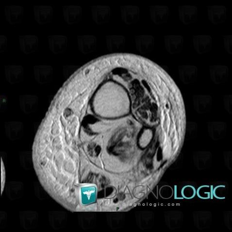 Erysipelas, Other soft tissues/nerves - Leg, MRI