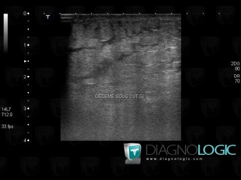 Erysipelas, Other soft tissues/nerves - Leg, US