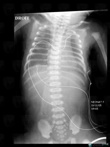 Esophageal atresia, Oesophagus, X rays