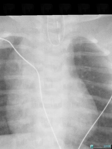 Esophageal atresia, Oesophagus, X rays