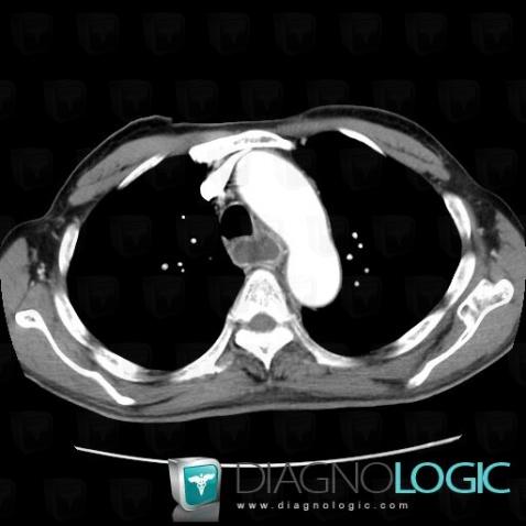 Esophageal cancer, Oesophagus, CT