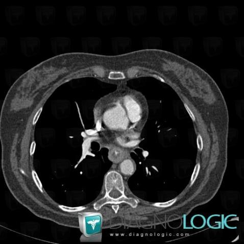 Esophageal cancer, Oesophagus, CT