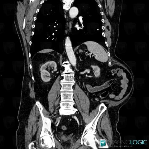 éventration, Paroi abdominale, Scanner