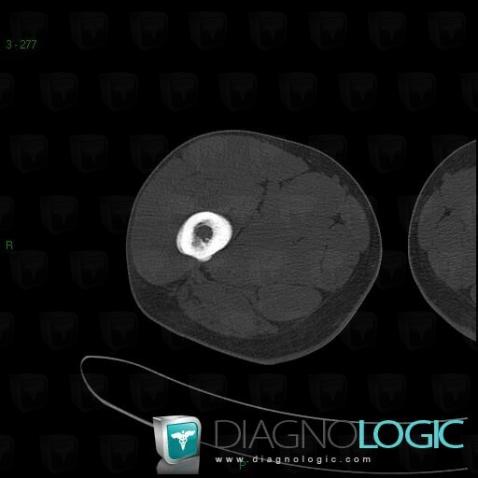 Ewing sarcoma, Femur - Mid part, CT