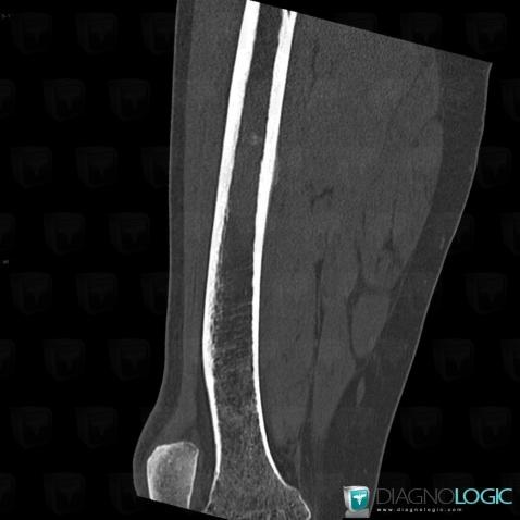 Ewing sarcoma, Femur - Mid part, CT