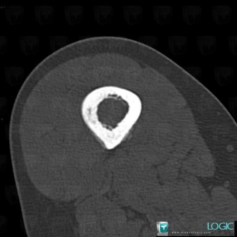 Ewing sarcoma, Femur - Mid part, CT