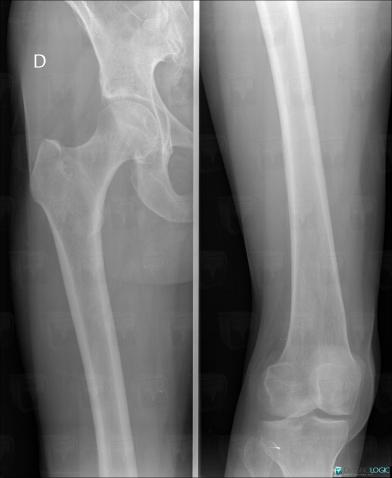 Ewing sarcoma, Femur - Mid part, X rays