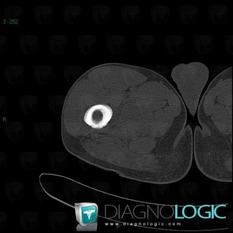 Ewing sarcoma, Femur - Proximal part, CT