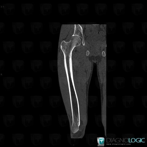 Ewing sarcoma, Femur - Proximal part, Femur - Mid part, CT