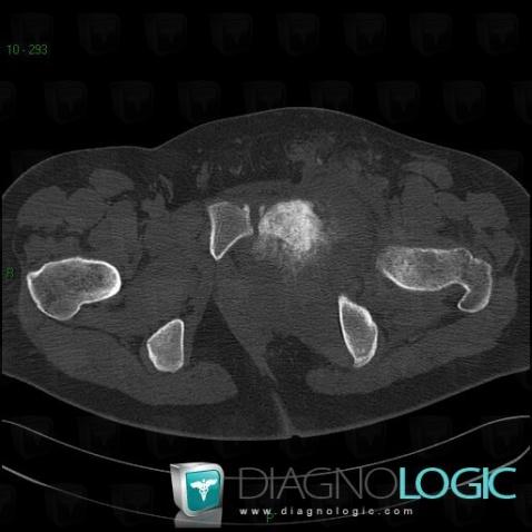 Ewing sarcoma, Ilium, CT