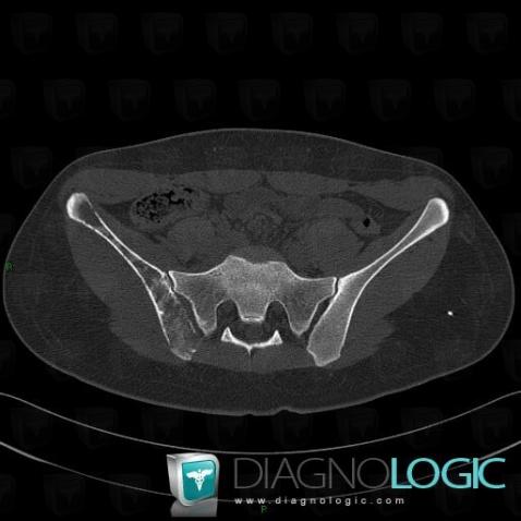 Ewing sarcoma, Ilium, CT