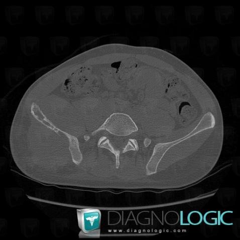 Ewing sarcoma, Ilium, CT