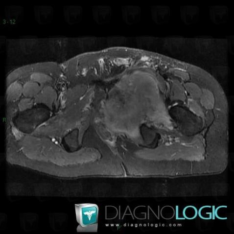 Ewing sarcoma, Ilium, MRI