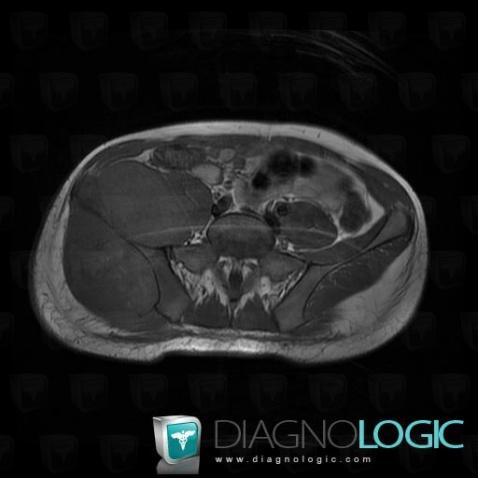 Ewing sarcoma, Ilium, MRI