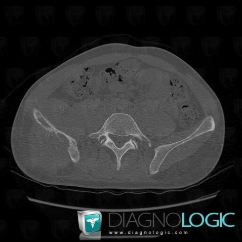 Ewing sarcoma, Ilium, Pelvic Muscles, CT