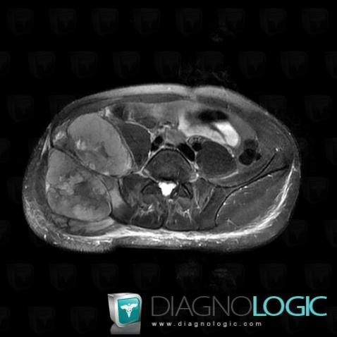 Ewing sarcoma, Ilium, Pelvic Muscles, MRI