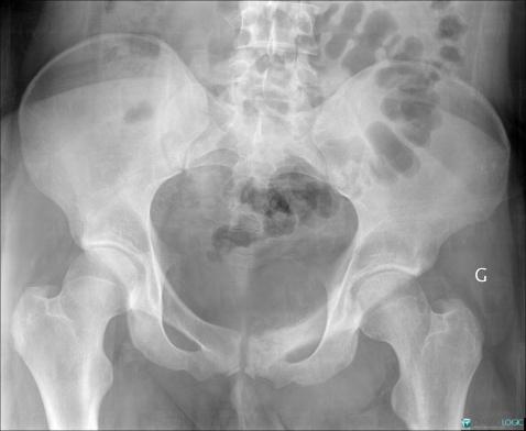 Ewing sarcoma, Ilium, X rays