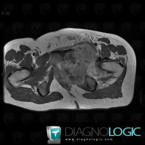 Ewing sarcoma, Pelvic Muscles, MRI