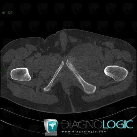 Ewing sarcoma, Pelvic Muscles, Other soft tissues/nerves - Pelvis, CT