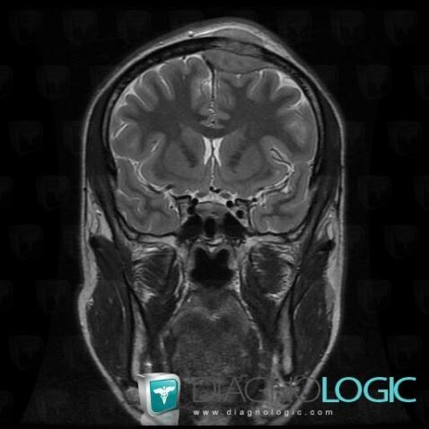 Ewing sarcoma, Skull vault, MRI