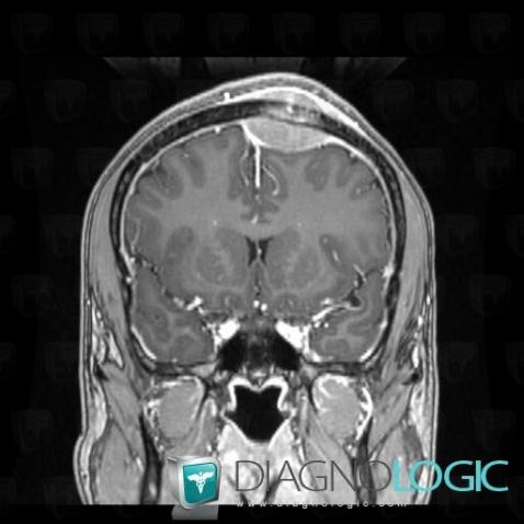 Ewing sarcoma, Supratentorial peri cerebral spaces, MRI