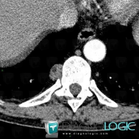 Extramedullary hematopoiesis, Mediastinum, Paraspinal, CT