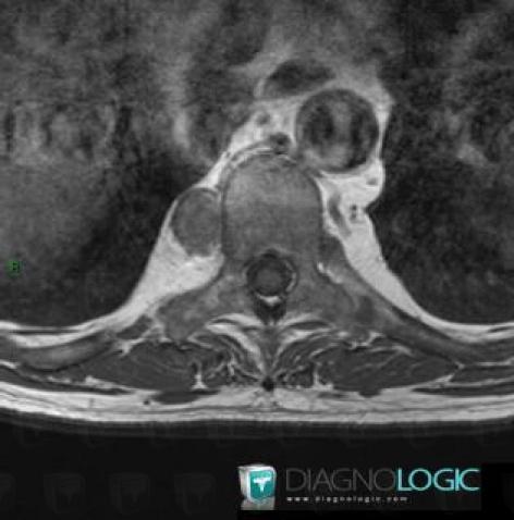 Extramedullary hematopoiesis, Mediastinum, Paraspinal, MRI