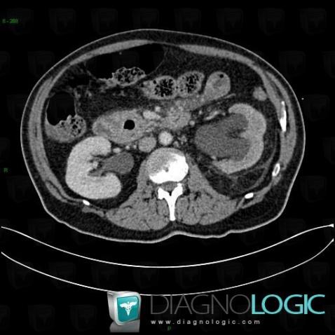 Extrarenal pelvis, Collecting system, CT