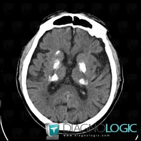 Fahr's disease, Basal ganglia and capsule, CT