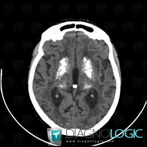 Fahr's disease, Basal ganglia and capsule, CT